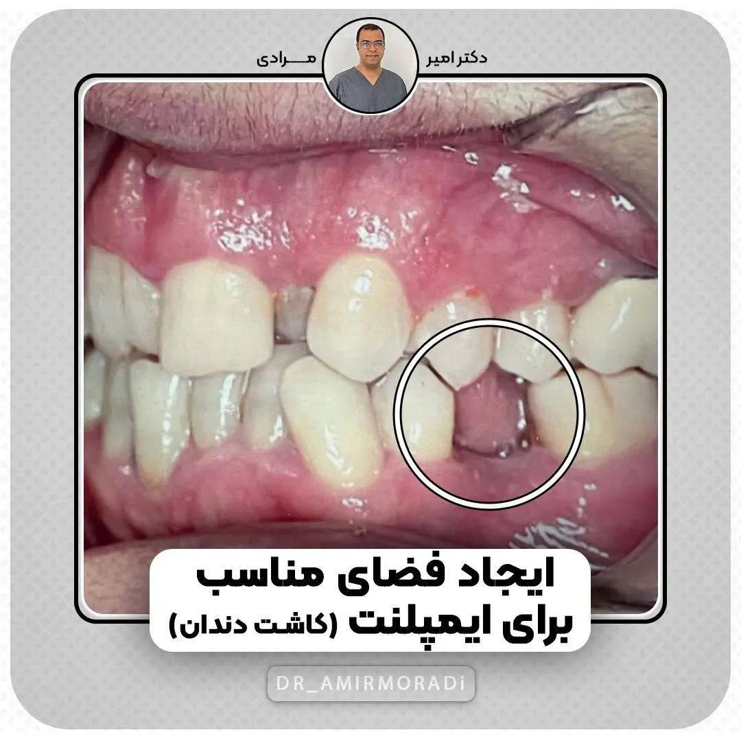 چه زمانی نیاز به ارتودنسی است